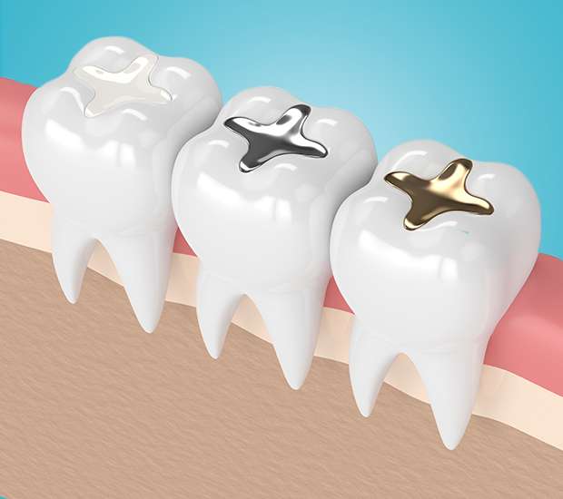 Deerfield Beach Composite Fillings