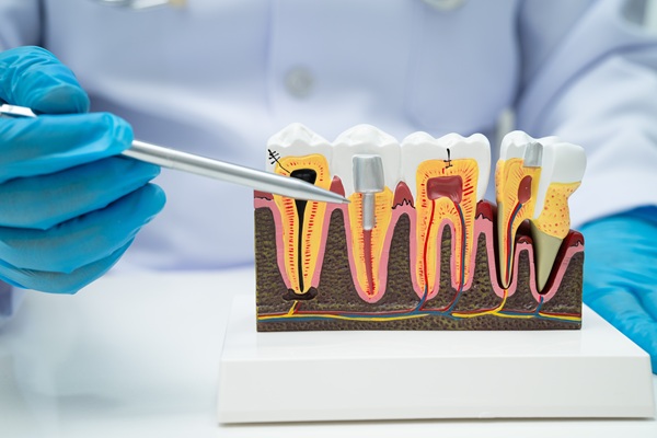 Common Concerns After Getting A Root Canal